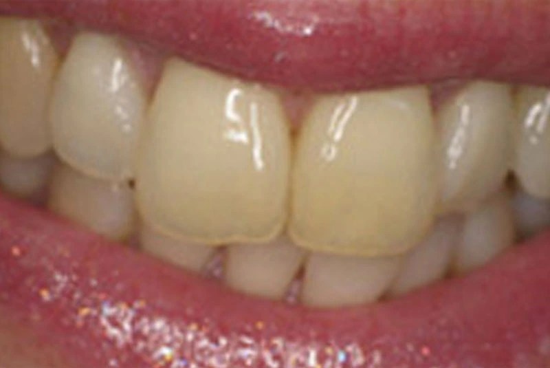 Porcelain Veneers Kirkland, WA Seattle's Best Smiles