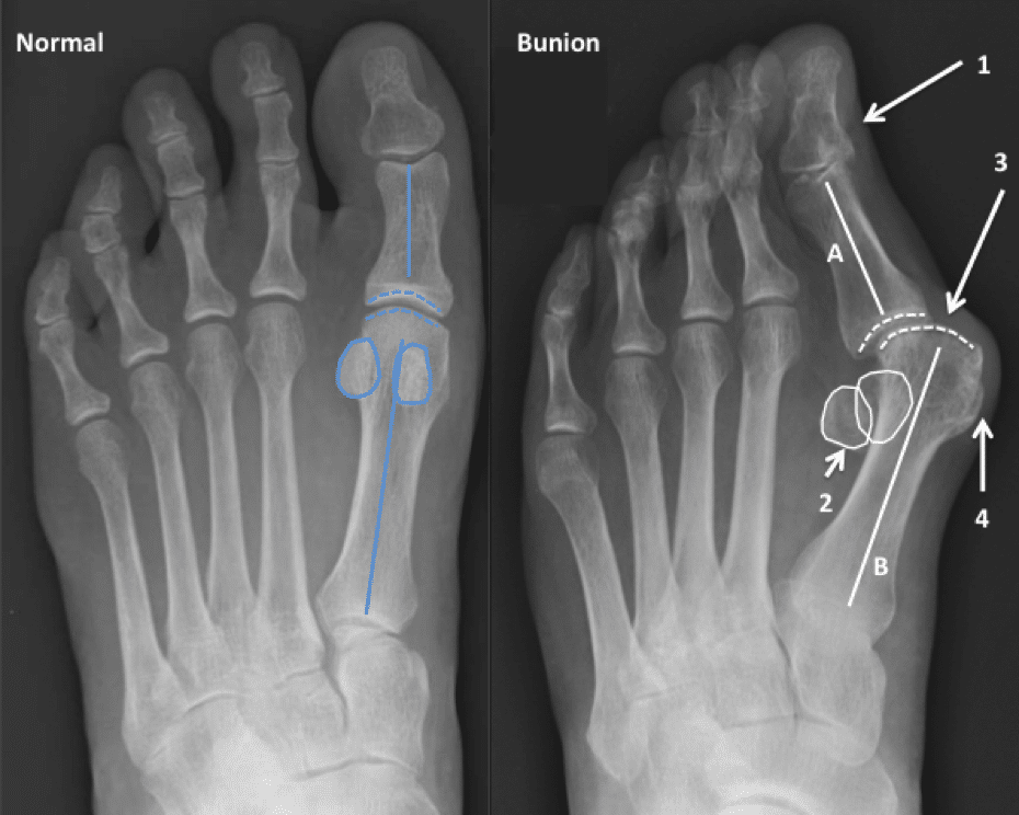 Bunion Treatment Foot Injury Treatment NJ Seaview Orthopaedics