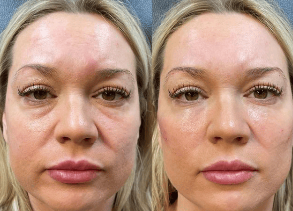 UnderEye Filler It's a Secret Med Spa