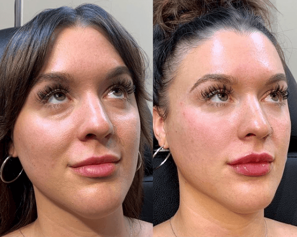 UnderEye Filler It's a Secret Med Spa