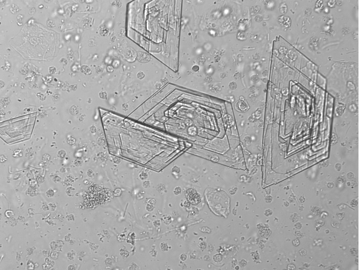 Cholesterol Crystals In Urine Sediment