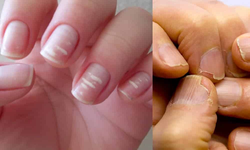 10 sinais de alerta que suas unhas podem mostrar Segredos do Mundo