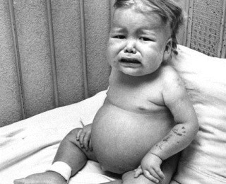 Marasmus : Definisi, Gejala, Faktor Risiko, Pencegahan | SEHAT.link