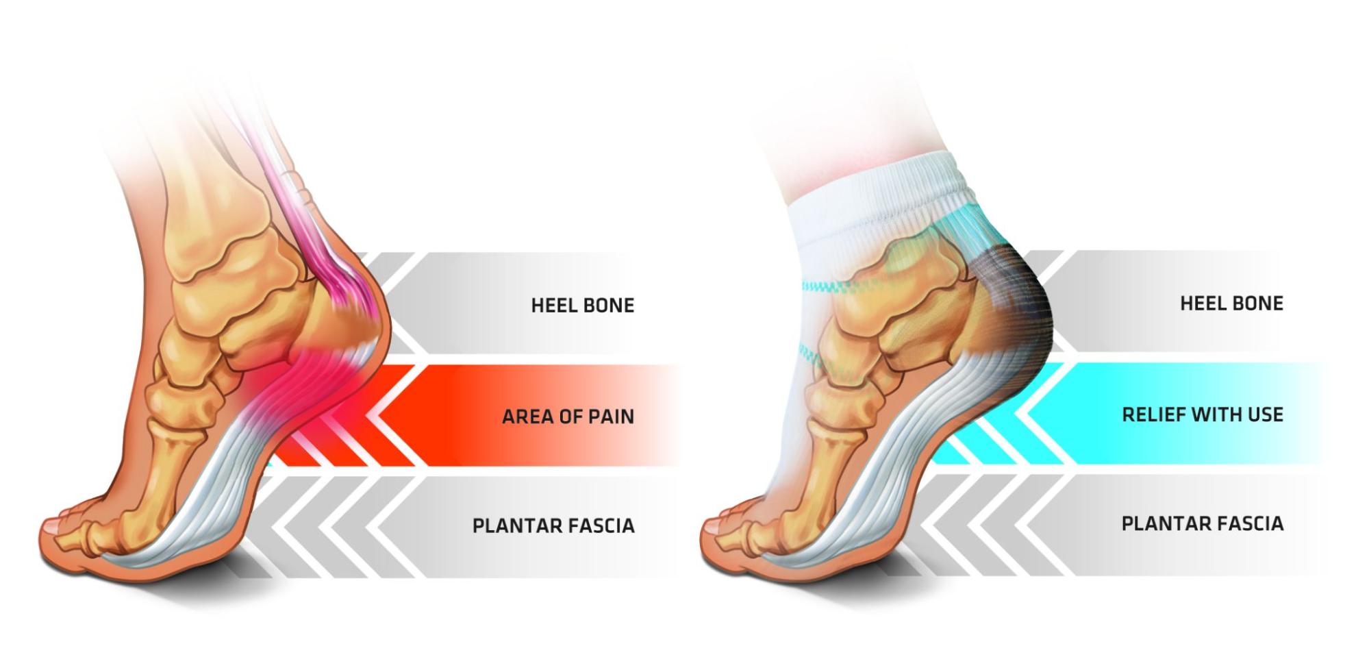 Bruised Heel Pad Causes, Symptoms, and Treatment SehatHub
