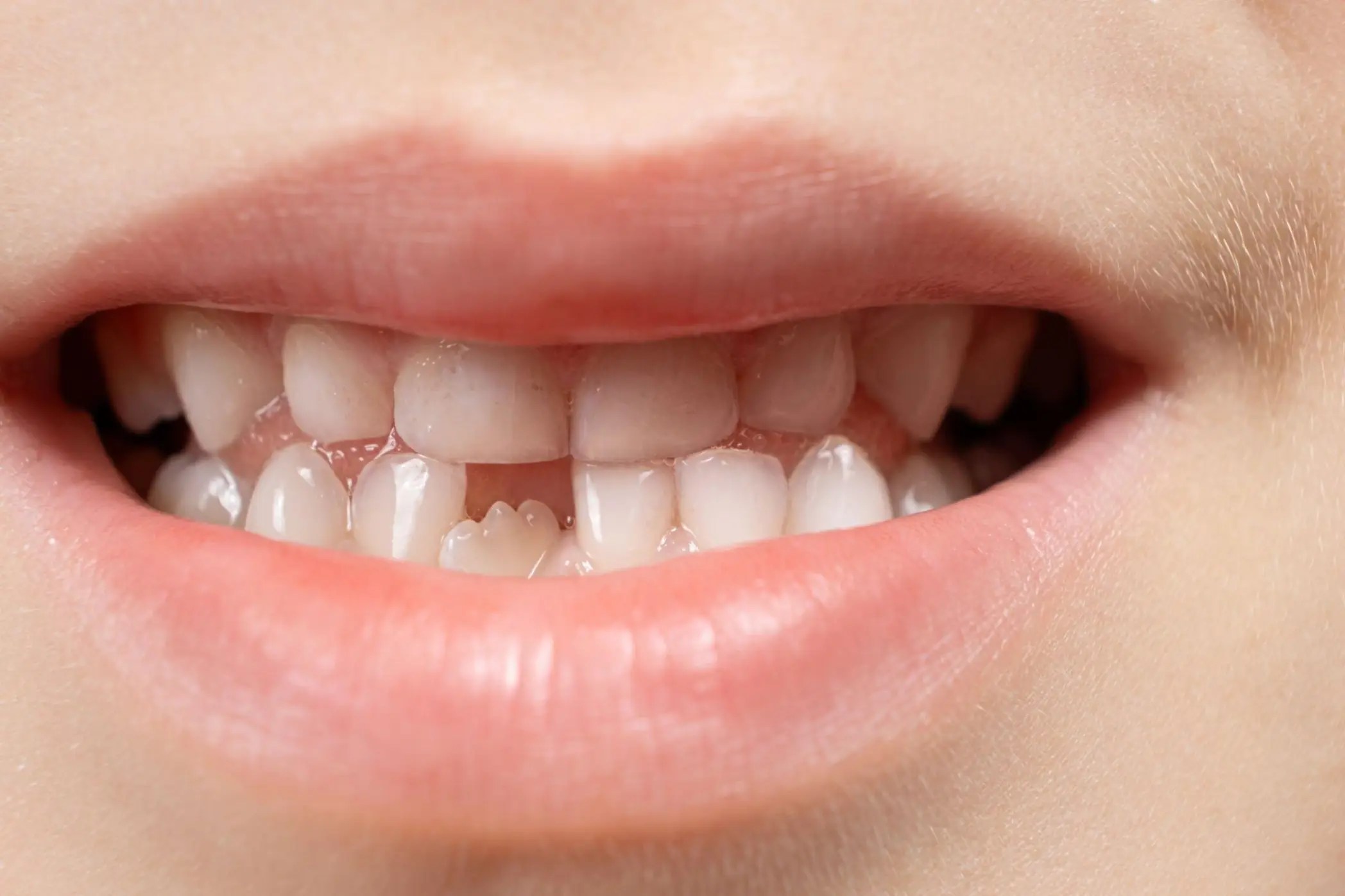 Your Guide to The Different Solutions for Complete Tooth Loss
