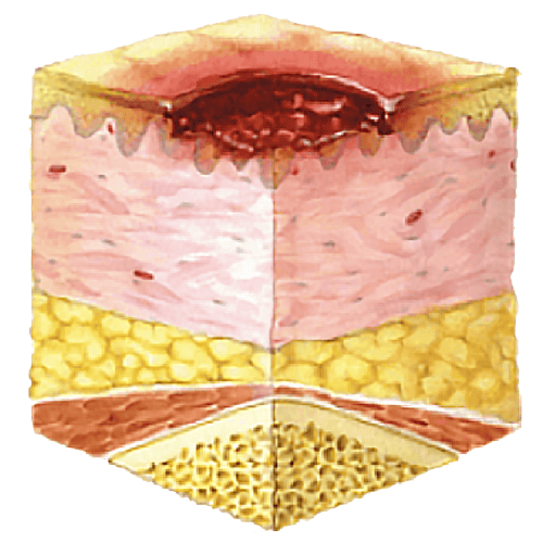 An introduction to Pressure Injuries SEM Scanner
