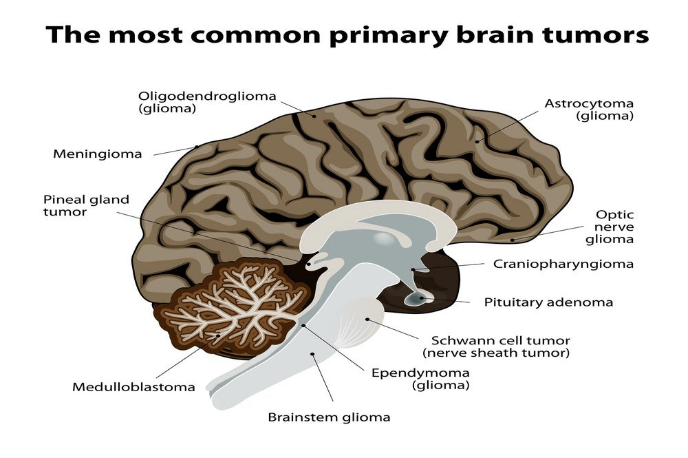 Brain Tumor Diagnosis and Treatment, Definition, Causes, Symptoms