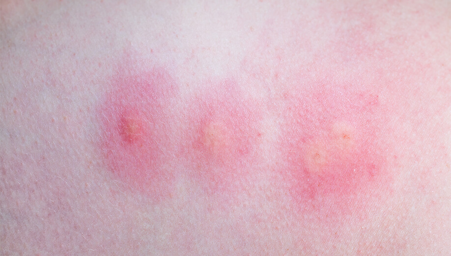 Identifying Common Insect Bites and Stings Sentinel Blog