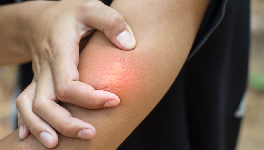 Identifying Common Insect Bites and Stings Sentinel Blog