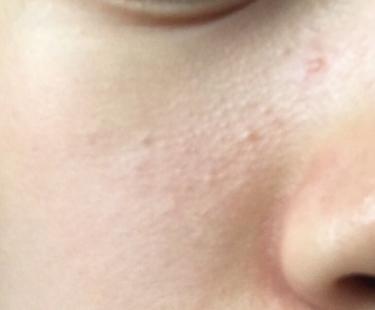 bumpy/textured skin?? Beauty Insider Community