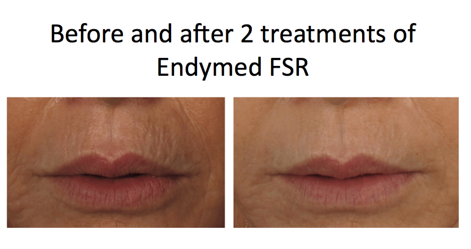 EndyMed Los Angeles A NonSurgical Alternative with Fantastic Results