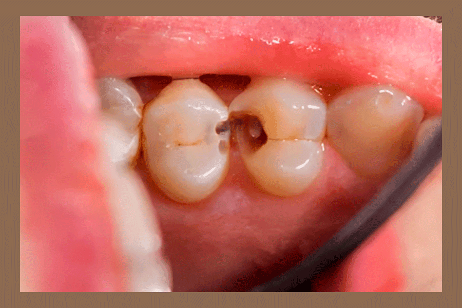 Benefits Of Tooth Filling More Than Just Repairing Cavities » Top