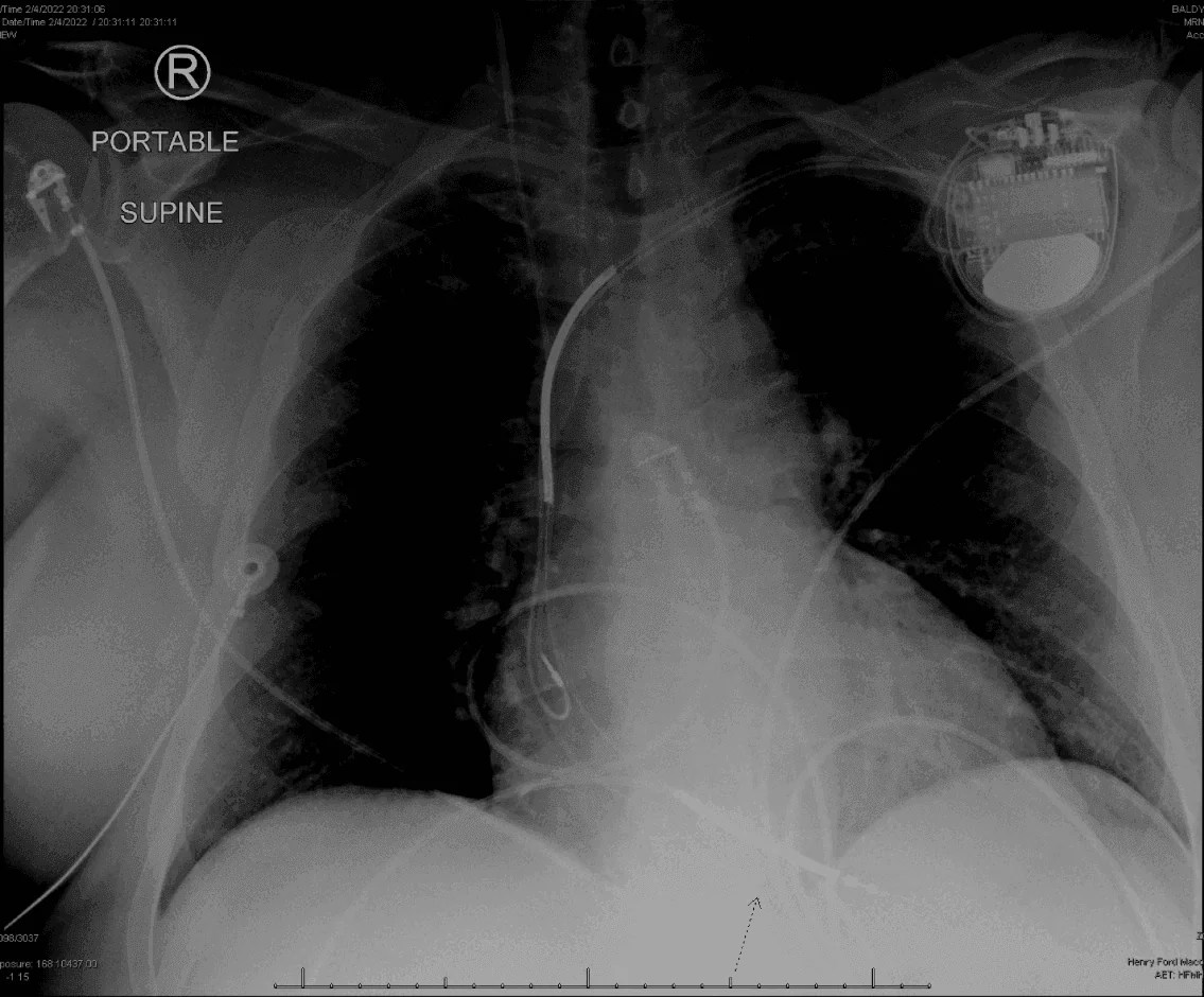 A HeartStopping Tale of a Simple Arm Movement. A Tragic Consequence of a Fractured Pacemaker Lead