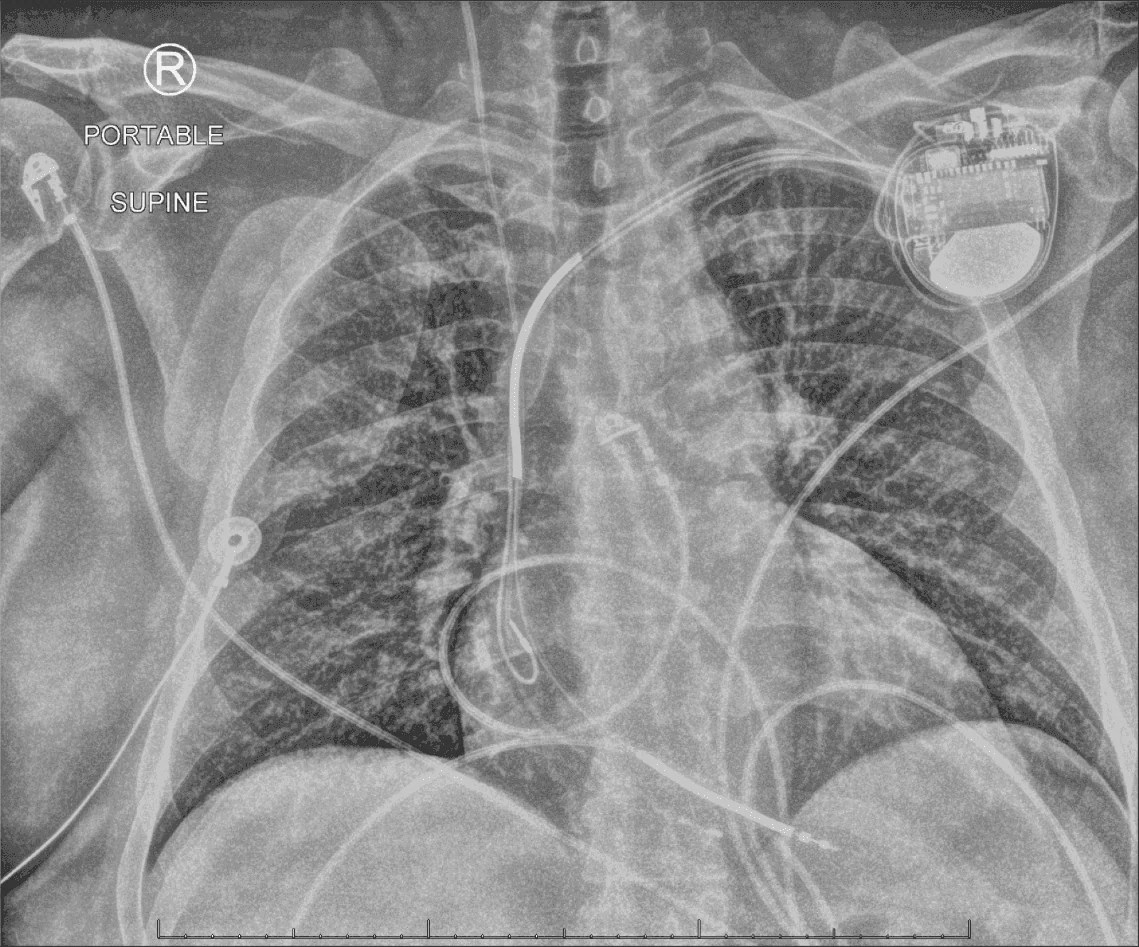 A HeartStopping Tale of a Simple Arm Movement. A Tragic Consequence of a Fractured Pacemaker Lead