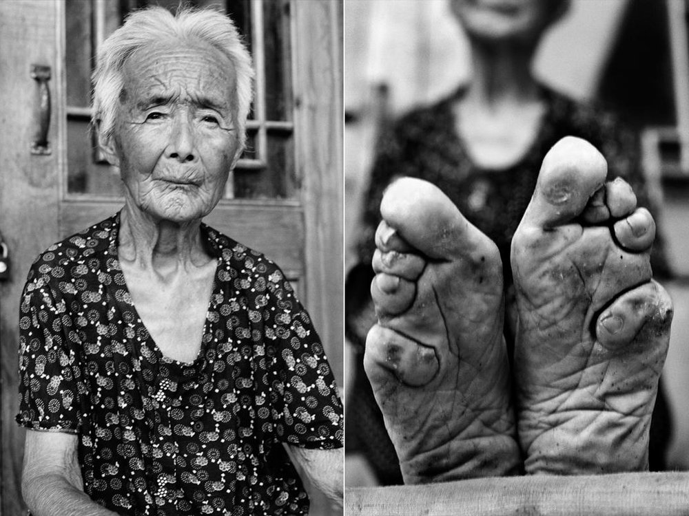 Outlawed Foot Binding Practice in China Sesame Disk