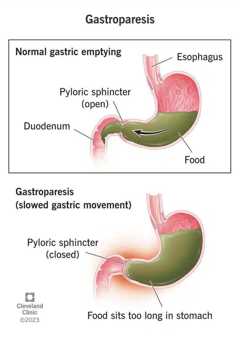 Gastroparees Sümptomid, Põhjused, Diagnoos Ja Ravi SFOMC