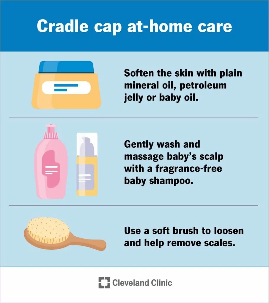 Cradle Cap (seborroiline Dermatiit Imikutel) Põhjused Ja Ravi SFOMC