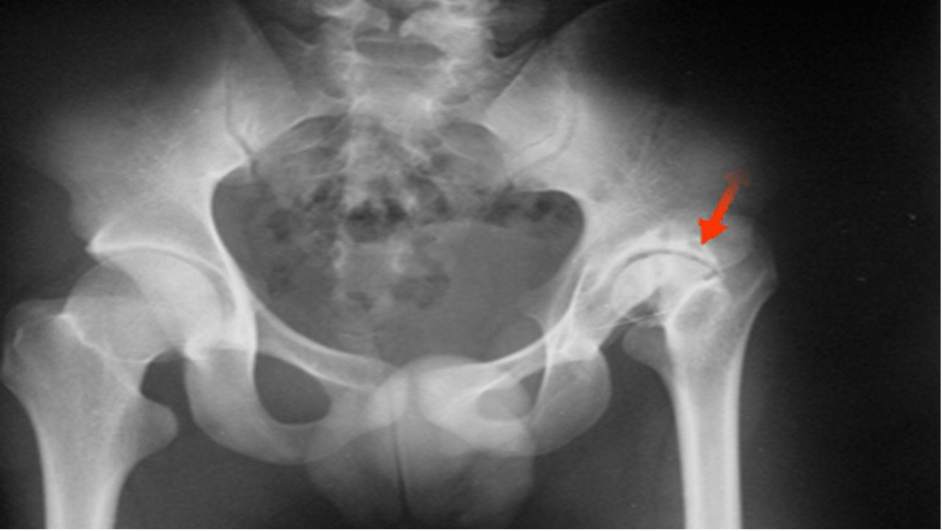 Rapid Destructive Hip Osteoarthritis When MRI And XRays, 44 OFF
