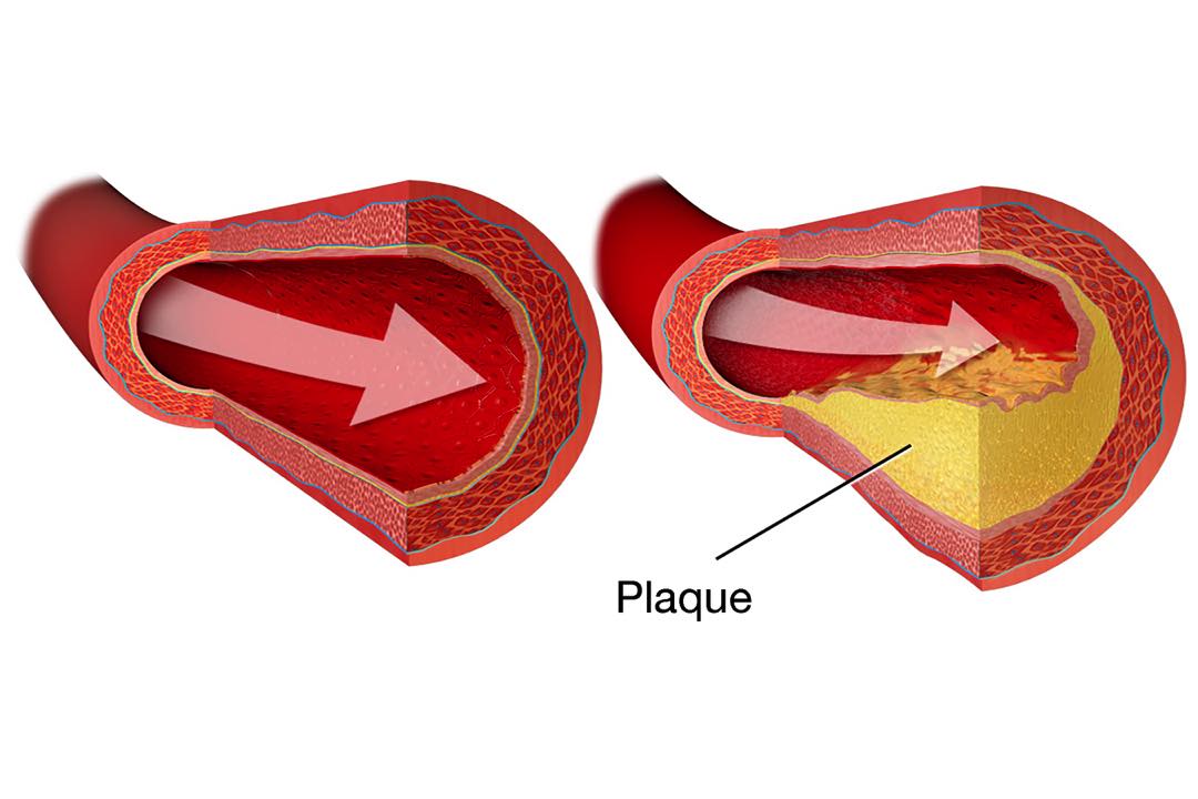Abdominal Aortic Aneuysm SFVVG