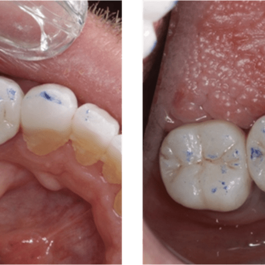 Lingual Braces Hanoi Da Nang Ho Chi Minh City