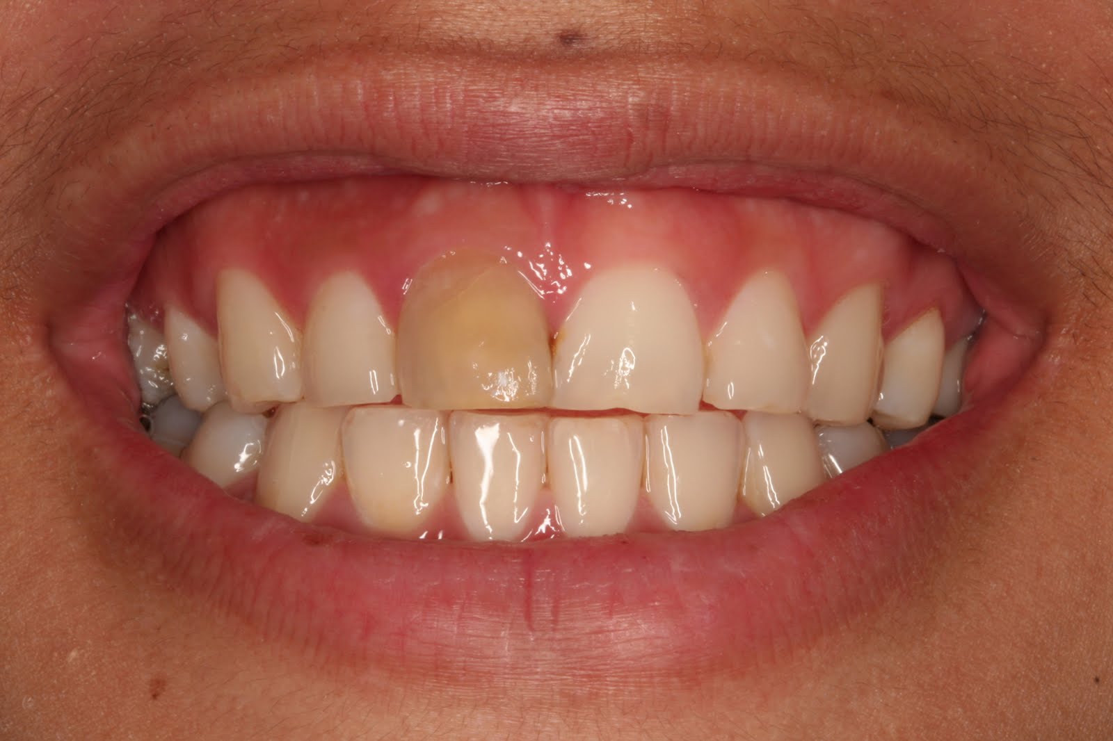 Internal bleaching in Vietnam Dentist, Cost, Procedures and Reviews