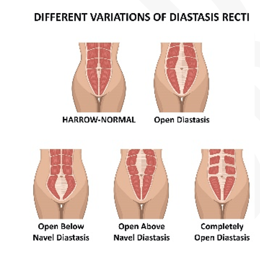 Diastasis recti – (RAD) | Specialists in General Surgery - SGS