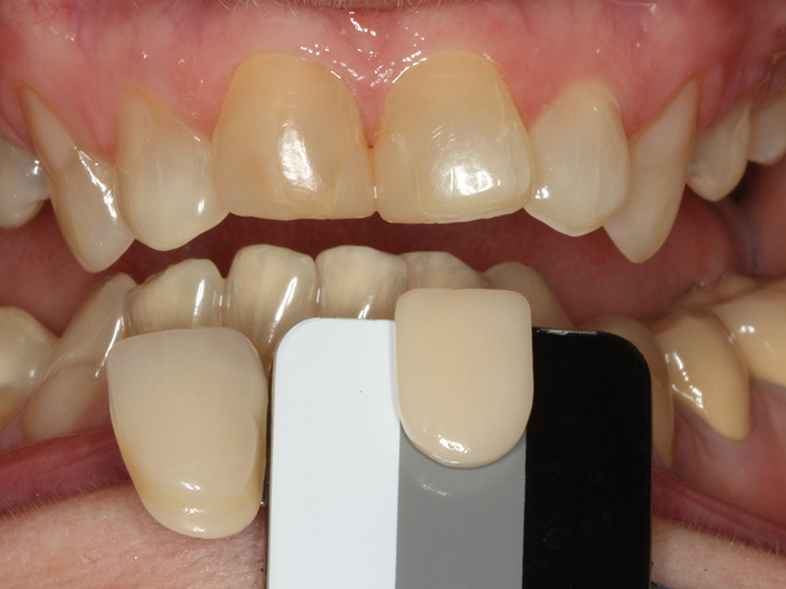 Modern Dental Lab USA ShadeWave