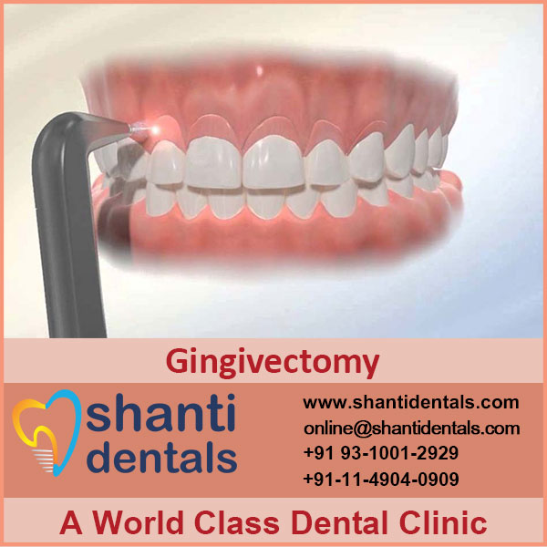 Gingivectomy Shanti Dentals