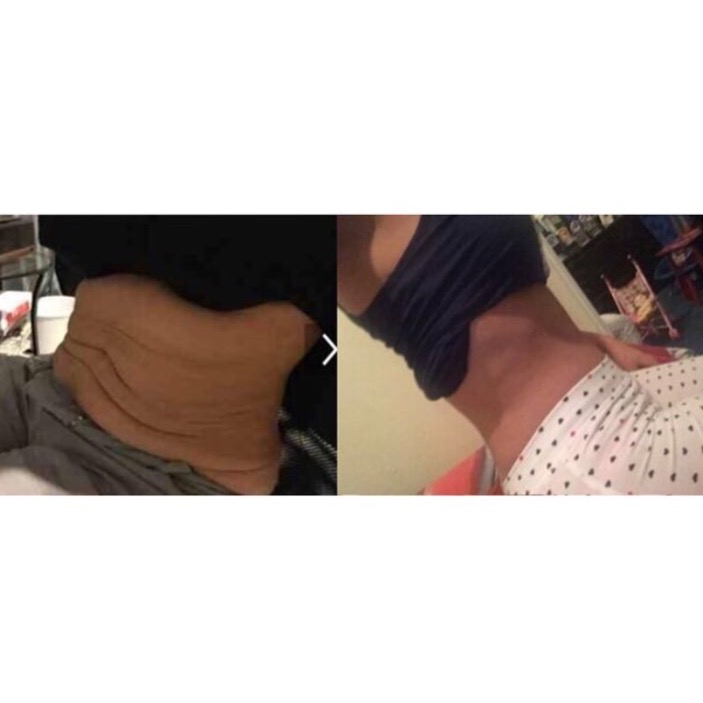 ABDOMINOPLASTY Dr Sejal Patel Beverly Hills Plastic Surgeon