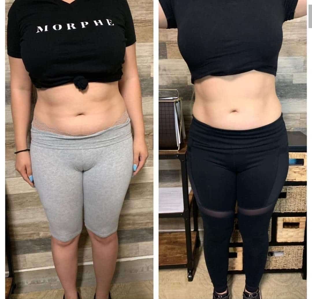 Body Contouring Services in Murrieta Shape it Up Contouring