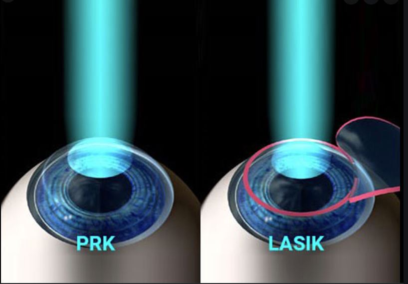 Next Gen Wavefront PRK Shows Incredible Results Shapiro Laser