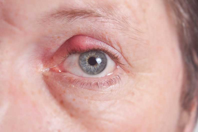 How to Treat an Eye Stye UPMC HealthBeat