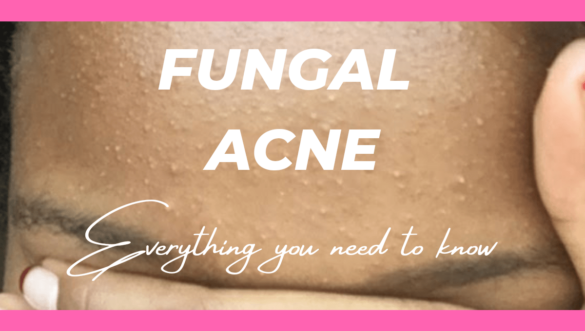 HOW TO GET RID OF FUNGAL ACNE Sharon Malonza