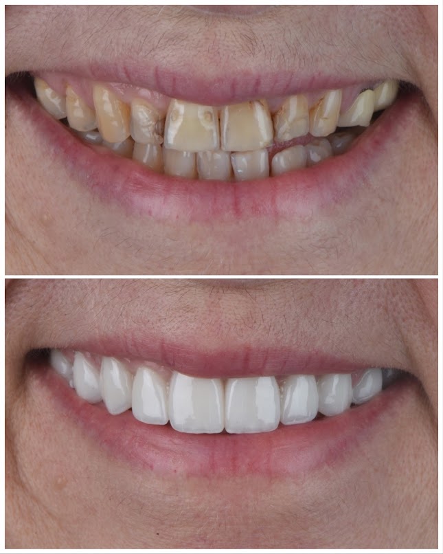 Porcelain Veneers in Miami FL Sharp Dentistry & Associates
