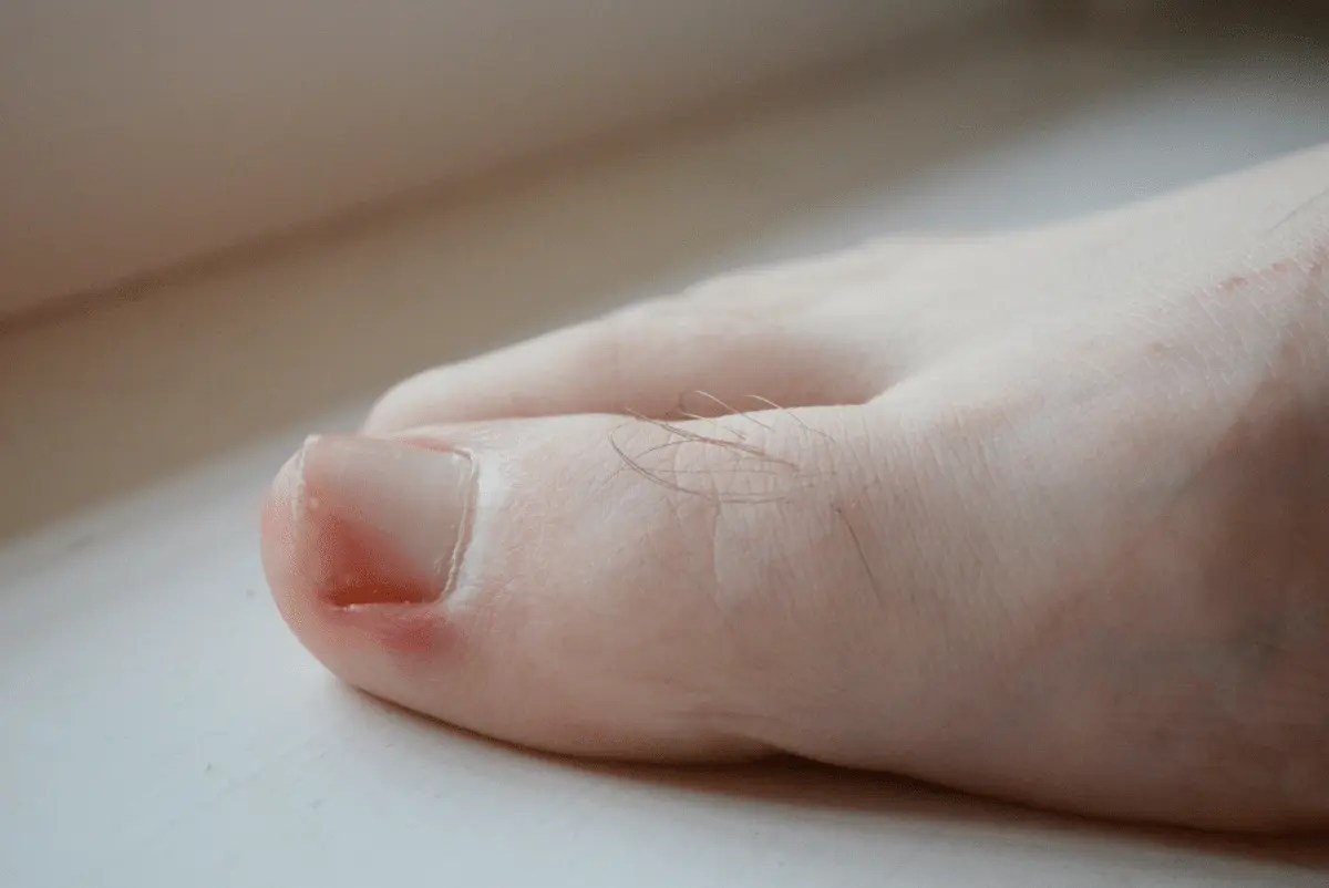 Can Ingrown Toenails Fix Themselves?