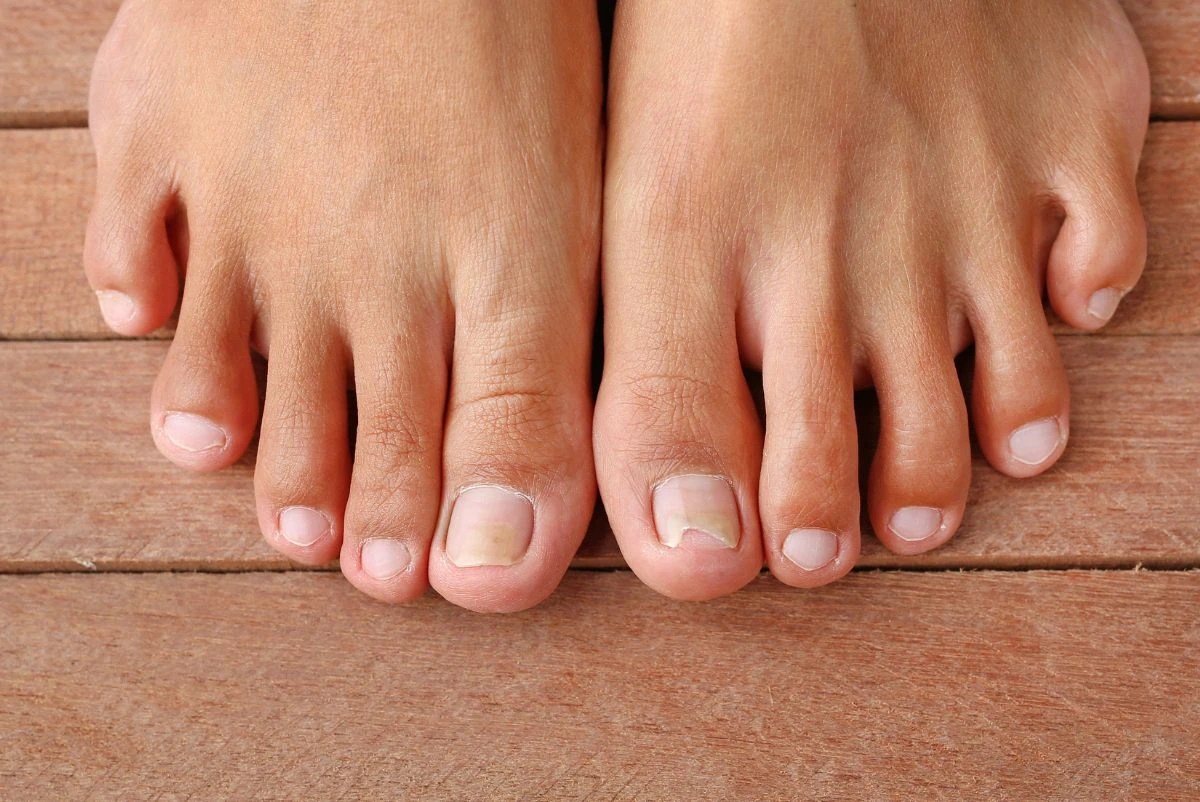 Why Do Toenails Curl Inward?