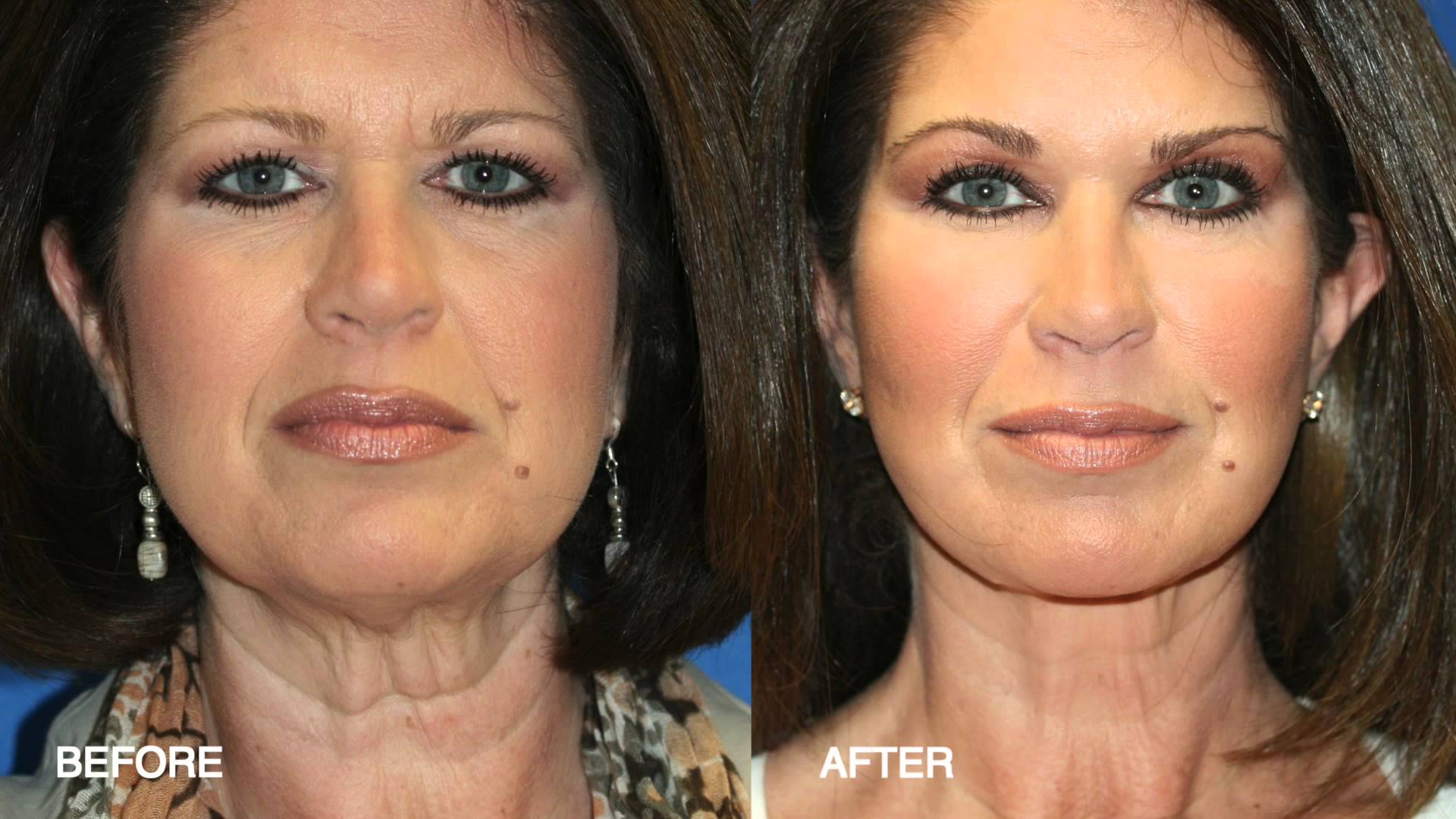 Fat Grafting and Fat Injection Sheraz Plastic Surgery