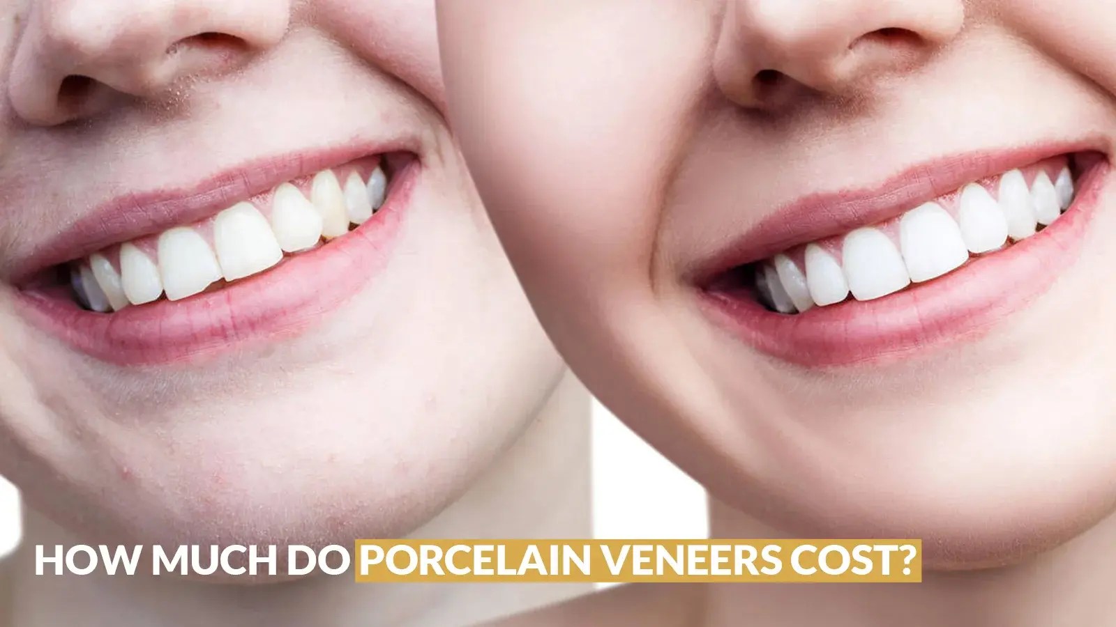 How Much do Porcelain Veneers Cost? What to Expect