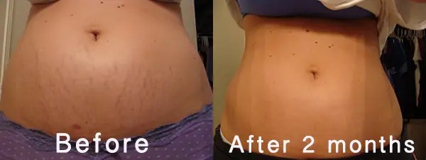 Using Shilajit to treat stretch marks