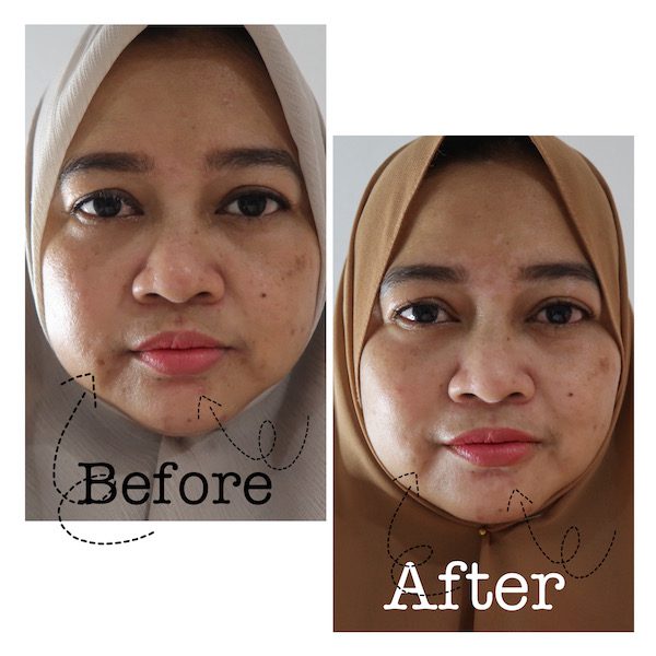 Review Perawatan Khusus Jerawat di ERHA Ultimate Acne Cure Shintaries