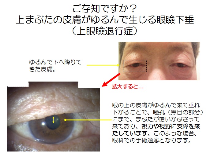 まぶた の 筋肉 病気 englshtris