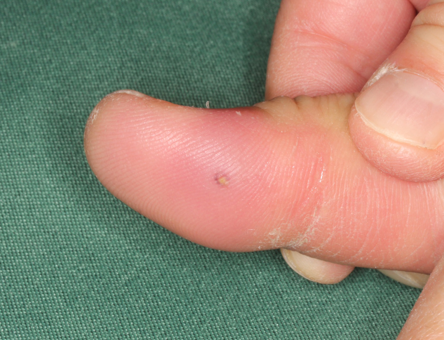 3 指にトゲが刺さったら | 白崎医院Blog 高岡市の皮ふ科 子どもの皮ふ 美容皮膚科