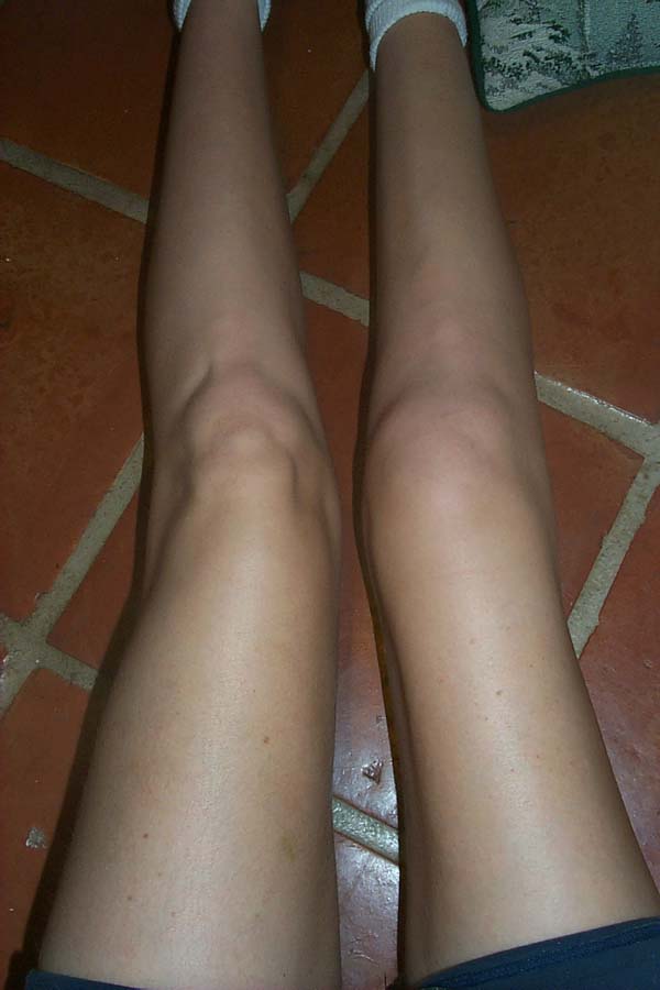 Broken kneecap need encouragement