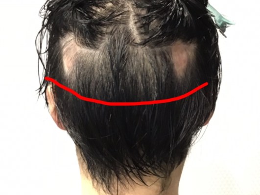 円形脱毛症をカットで目立たなくする髪形のご紹介