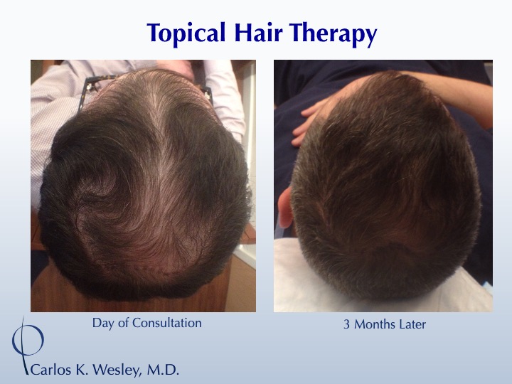 Finasteride Scalp Spray Carlos K. Wesley, M.D.