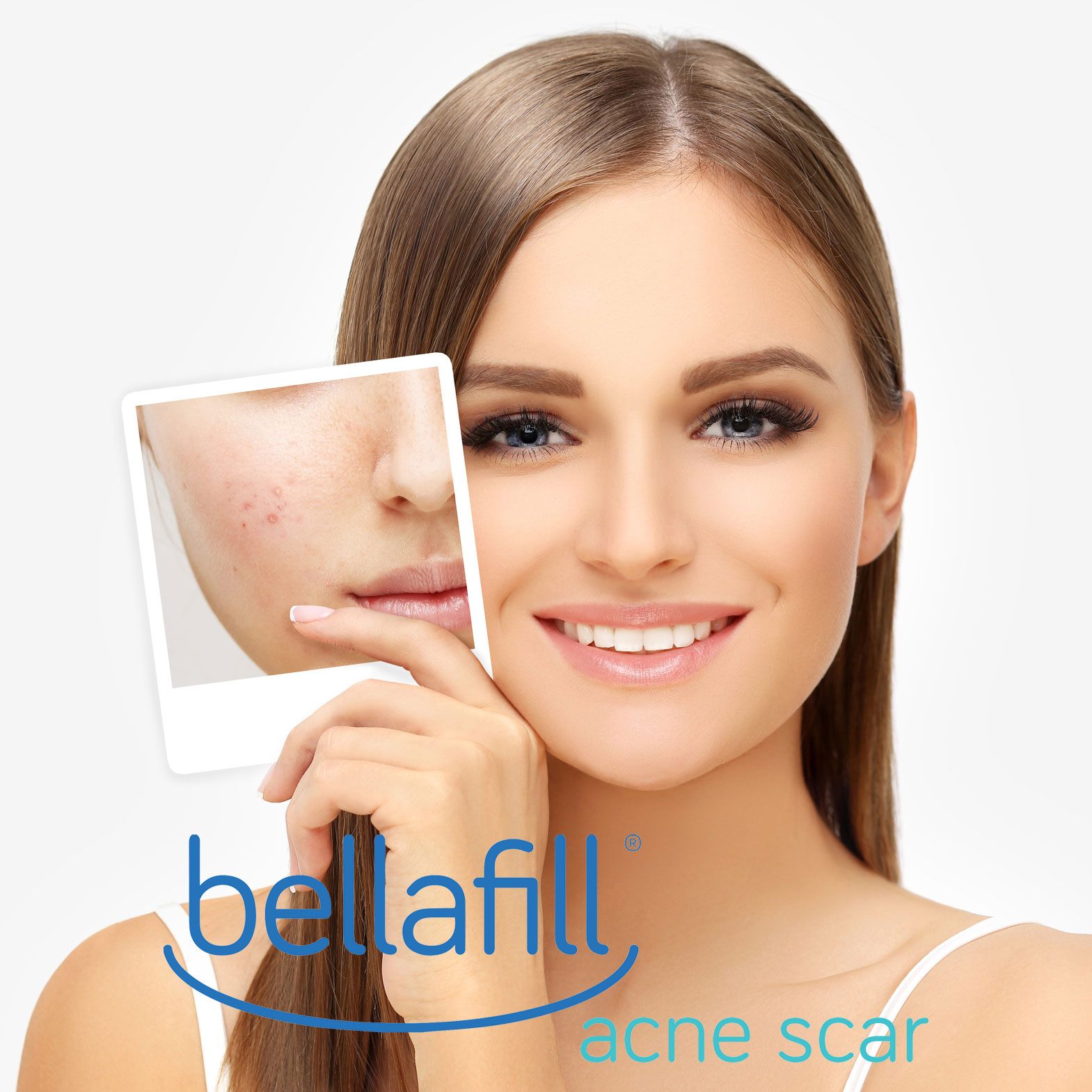 Bellafill® Dermal Filler for Acne Scars » Premier Dermatology