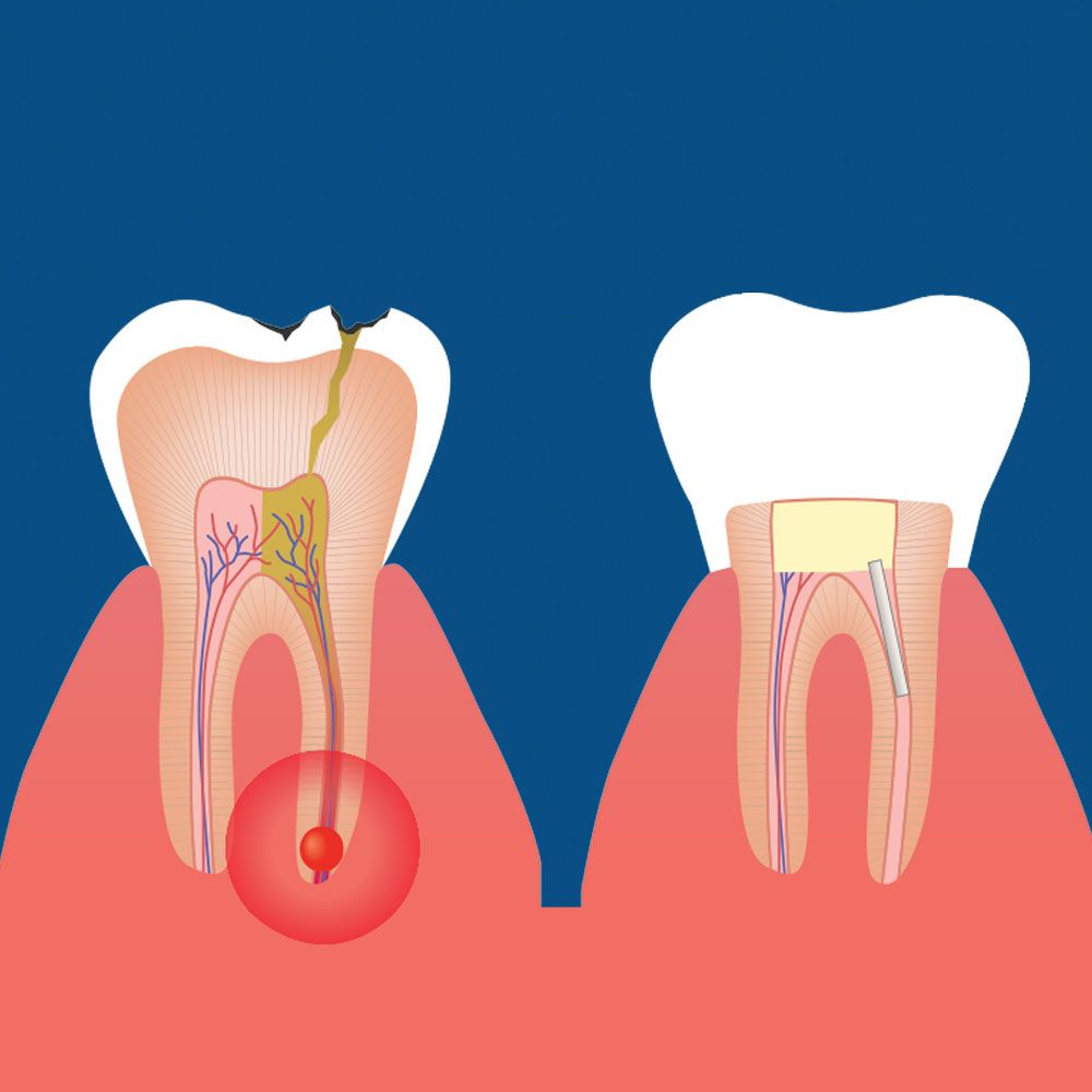 What are the treatments for a failed root canal? Shore Endodontics
