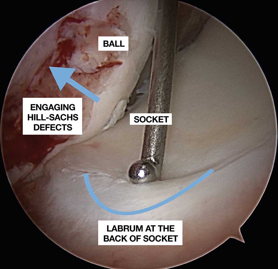 Arthroscopic Bankart Repair Dr. Raman Kant Aggarwal