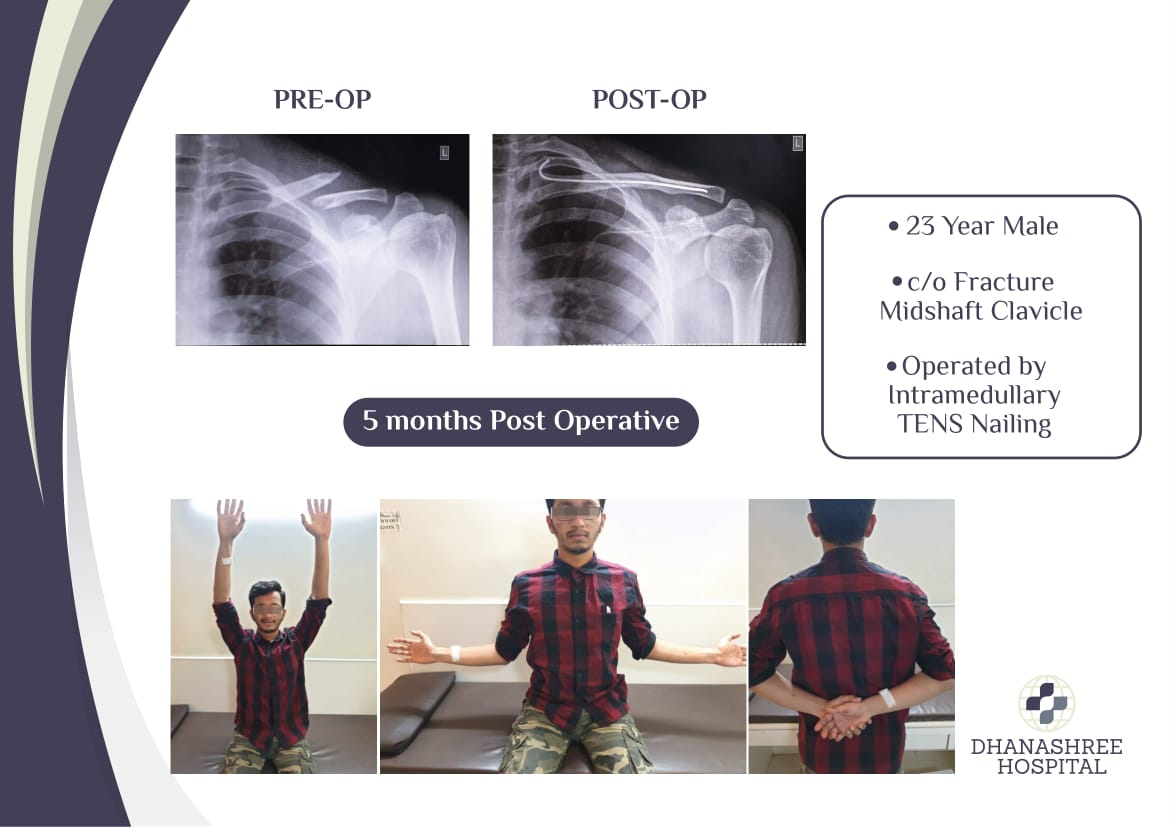 Shoulder Specialist In Pune Shoulder Specialist Doctor Shoulder