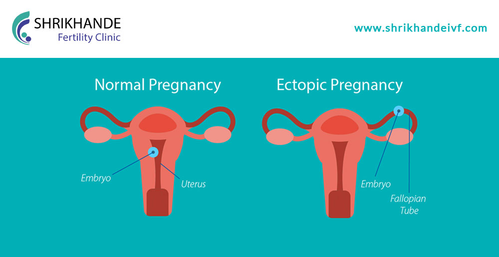 What leads to Ectopic pregnancy?
